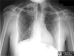Sprengel's Deformity